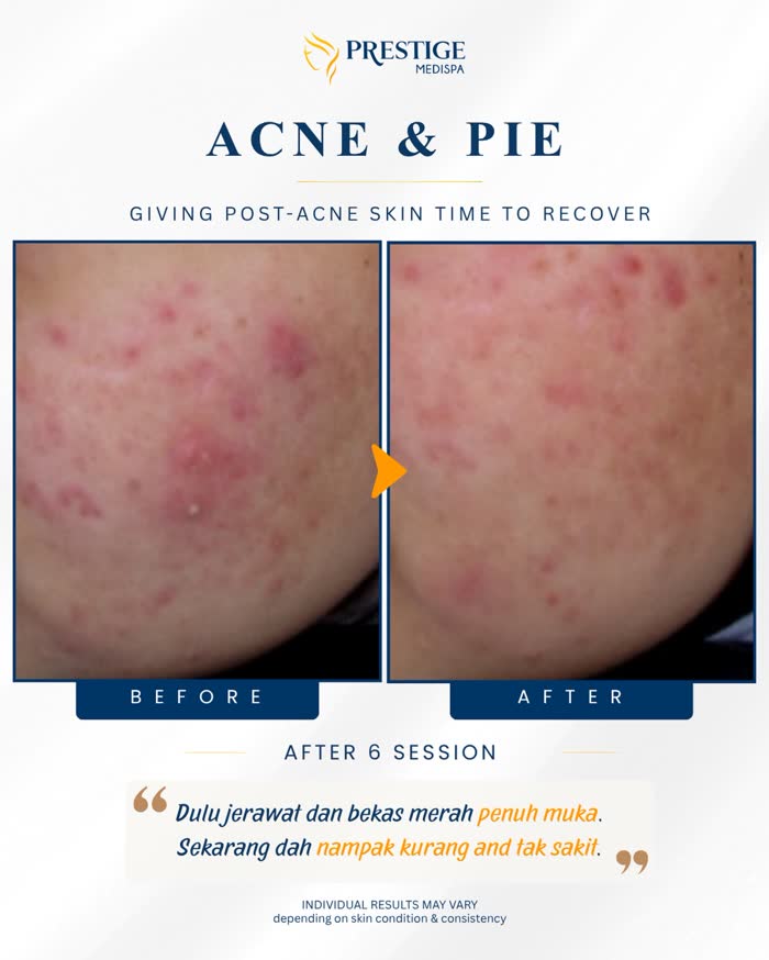Acne and post-acne marks before and after at Prestige Medispa