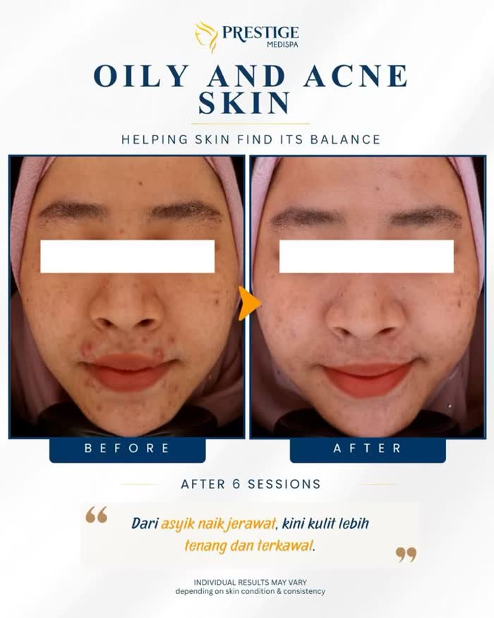 Oily and acne prone skin before and after at Prestige Medispa