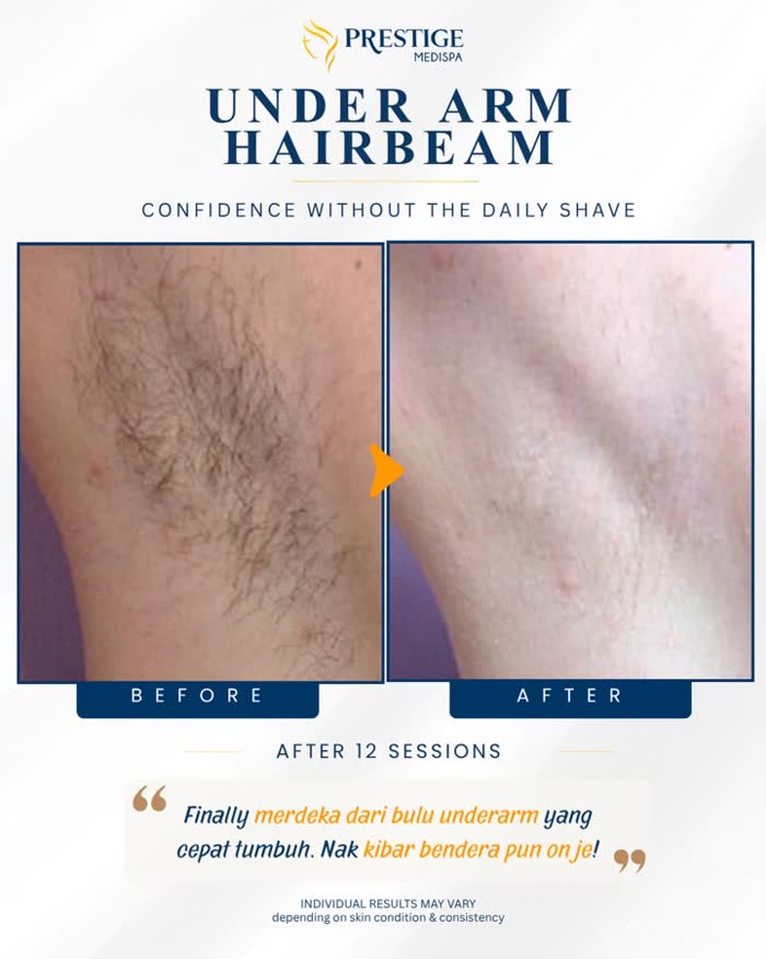 Underarm hair removal before and after at Prestige Medispa