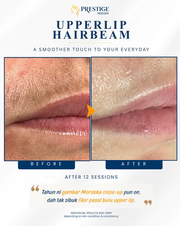 Upper lip hair removal before and after at Prestige Medispa