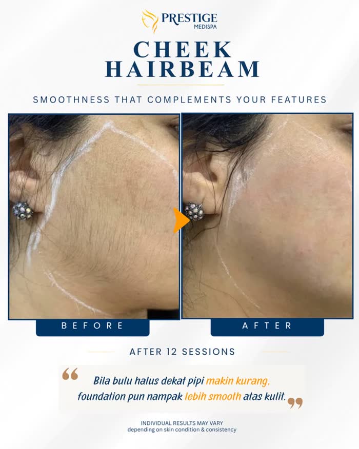 Cheek hair removal before and after at Prestige Medispa
