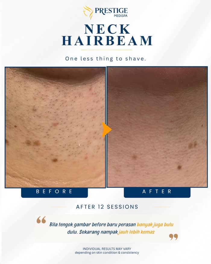 Neck hair removal before and after at Prestige Medispa