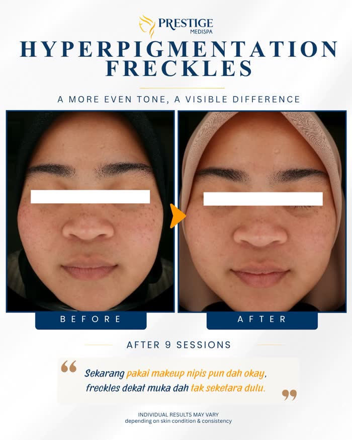 Hyperpigmentation and freckles before and after at Prestige Medispa