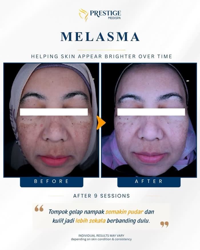Melasma before and after at Prestige Medispa