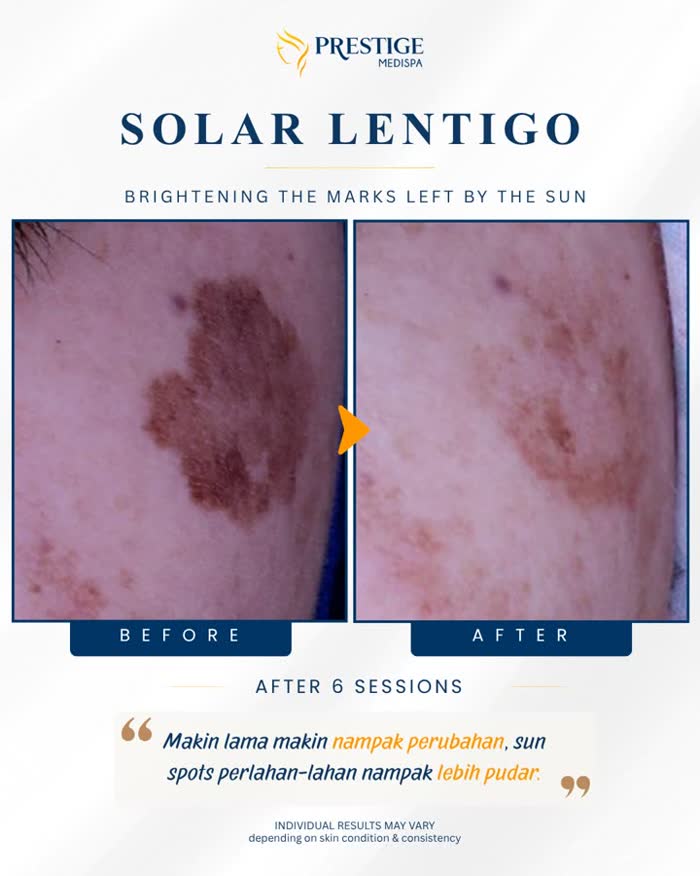 Solar lentigo before and after at Prestige Medispa