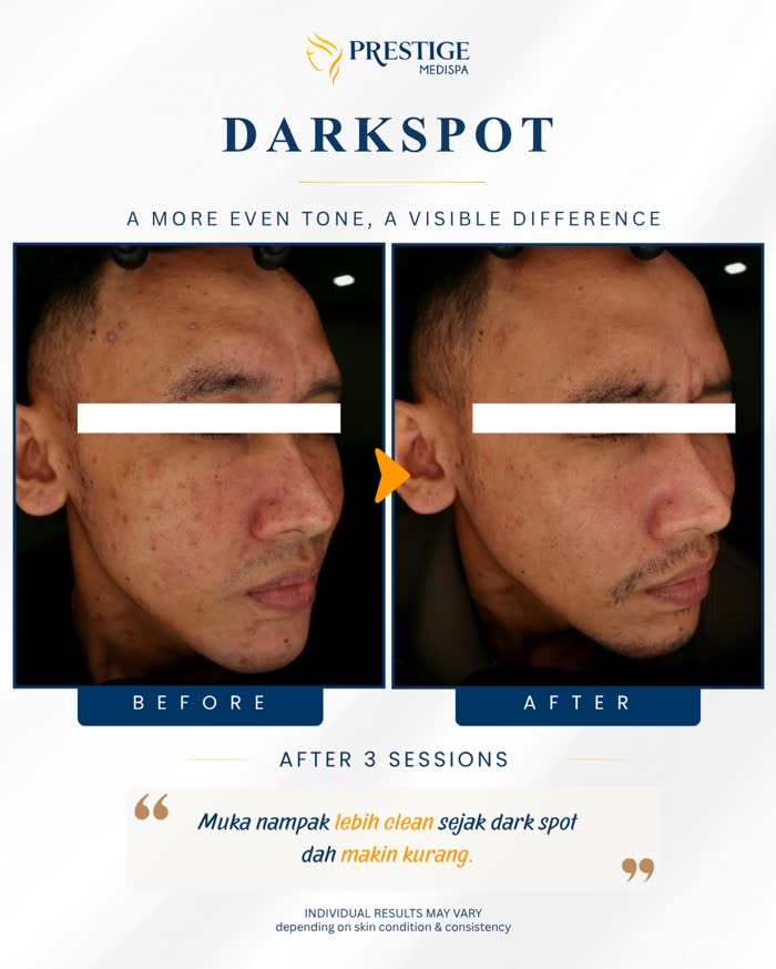 Dark spots before and after at Prestige Medispa