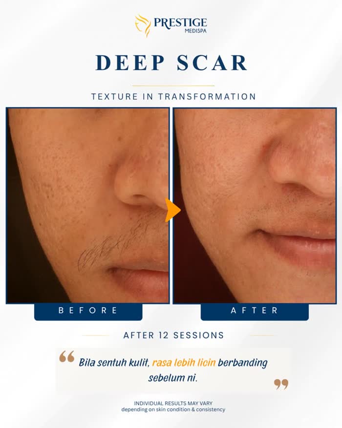 Deep scarring before and after at Prestige Medispa