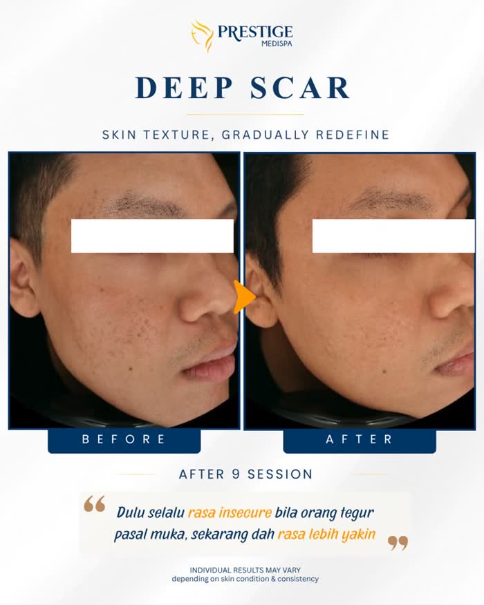 Skin texture improving after treatment at Prestige Medispa